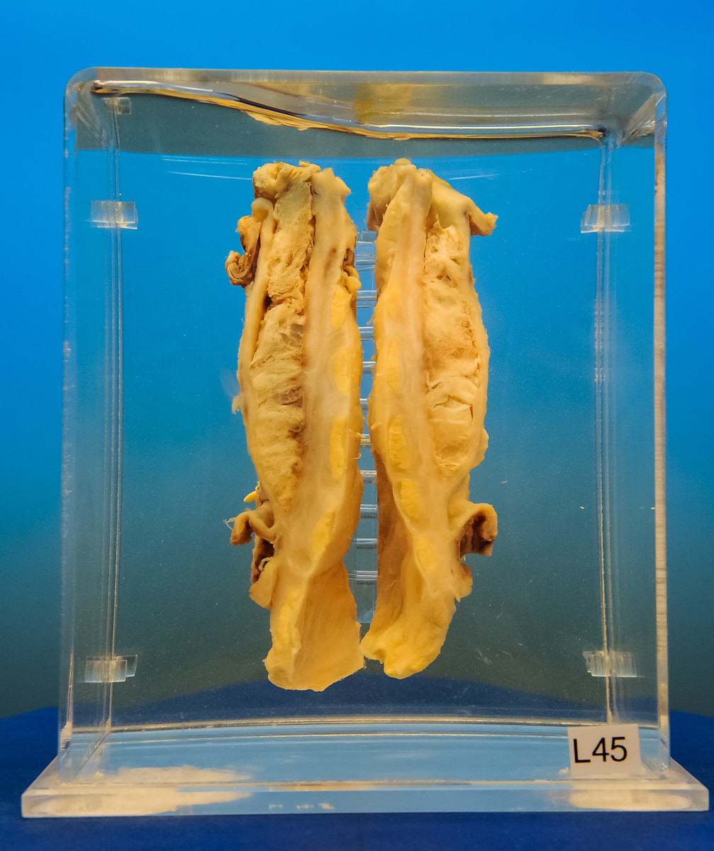 8f121e09 Gif Decortication Of Lung Prodcedure